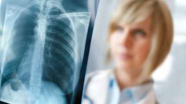 Pneumothorax 58 Pneumothorax