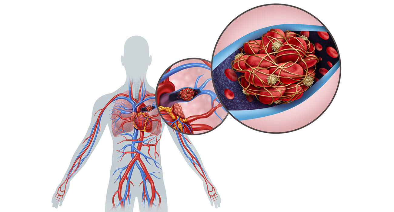 PULMONARY EMBOLISM (Blood Clots in the Lungs)
