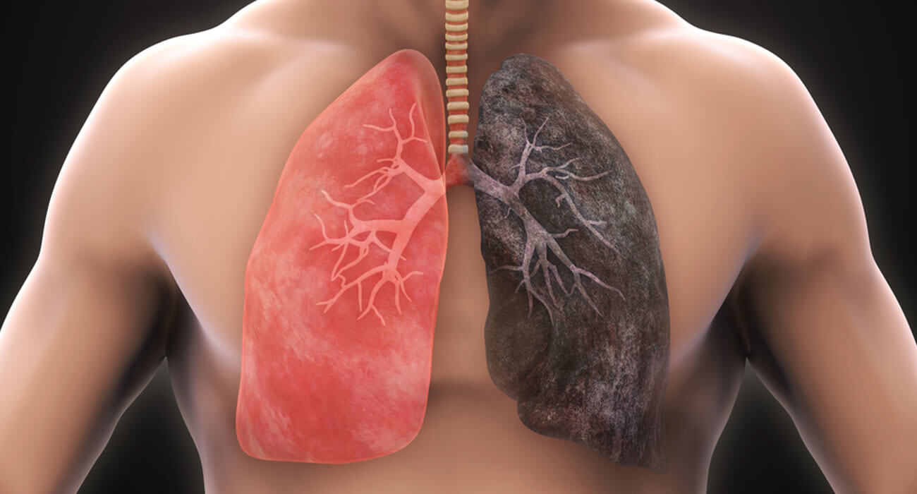 Here is everything you need to know about COPD( Chronic Obstructive Pulmonary Disease)