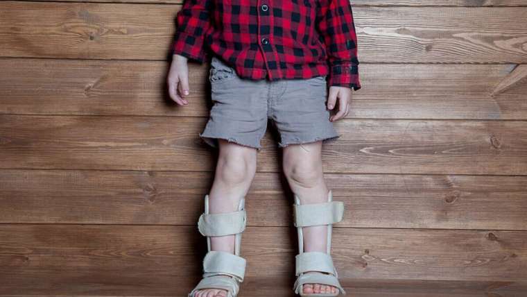 Rickets Treatment