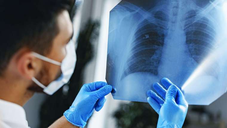 Lung Cancer
