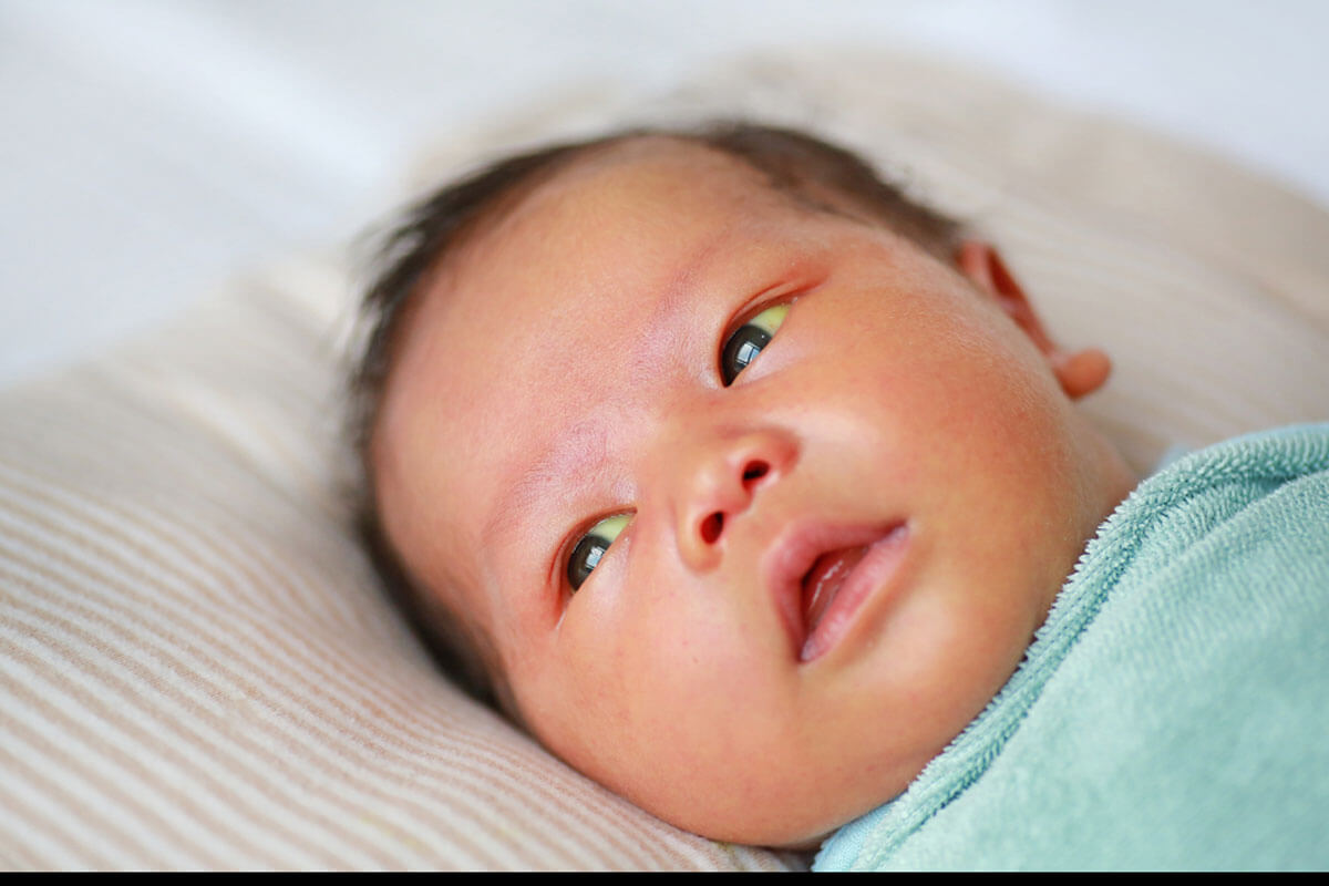 Jaundice: Causes, symptoms, and treatments
