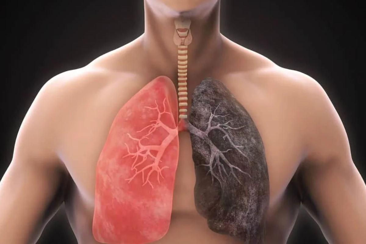 Chronic Obstructive Pulmonary Disease: Symptoms, Causes & Treatment